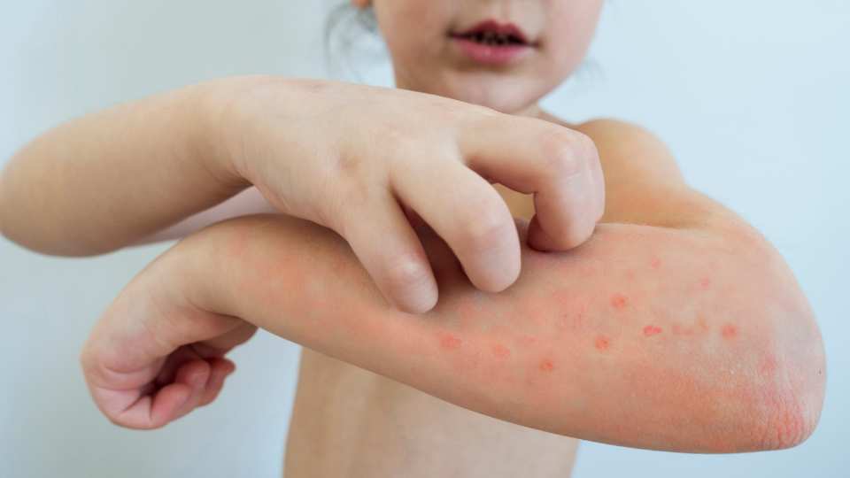 chickenpox vaccine in london