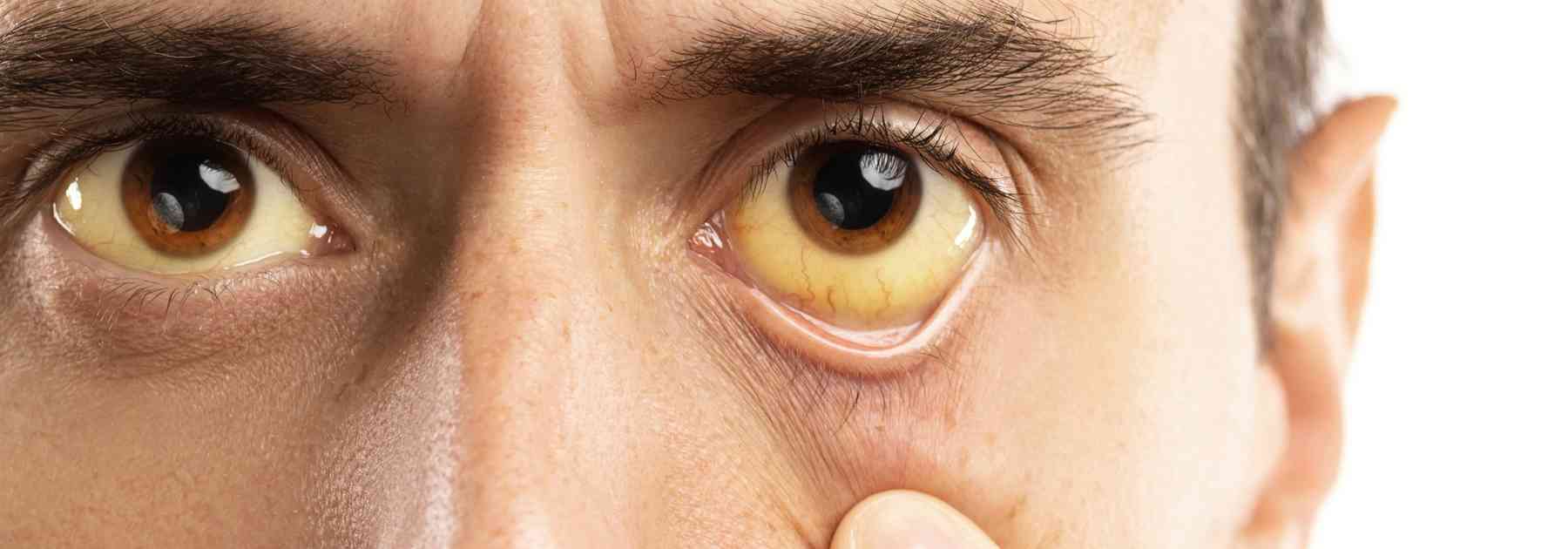 Yellow fever can cause jaundice