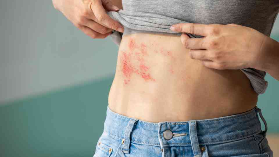 Shingles rash and vaccination eligibility